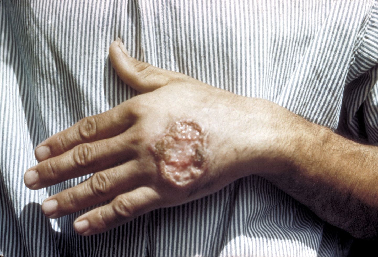 Болячки, которые появляются на коже при лейшманиазе.