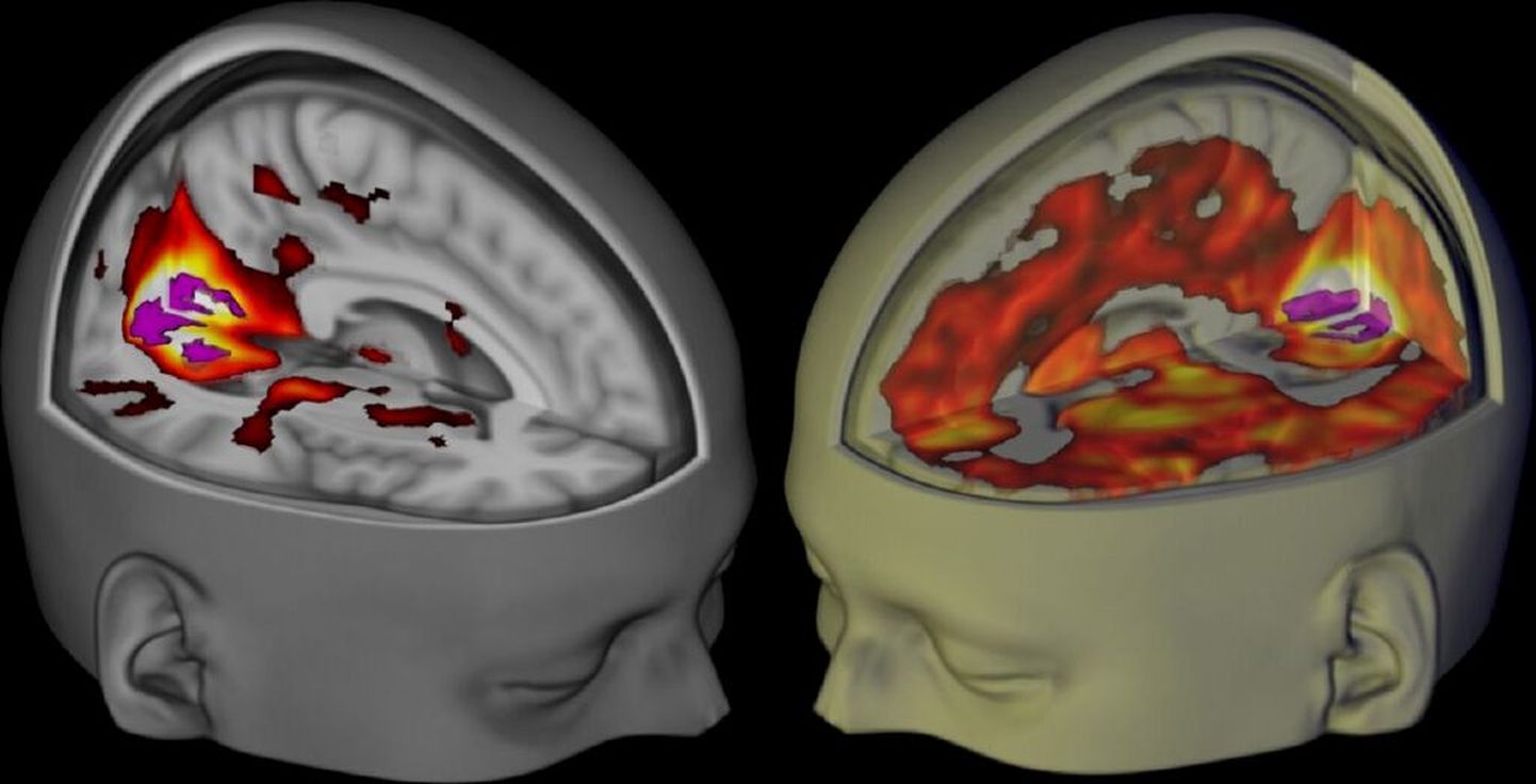 Teadlased avalikustasid esimesed pildid, mis näitavad, kuidas LSD mõjutab inimeste aju. Vasakul platseebo efekt ajus ja paremal LSD mõju.