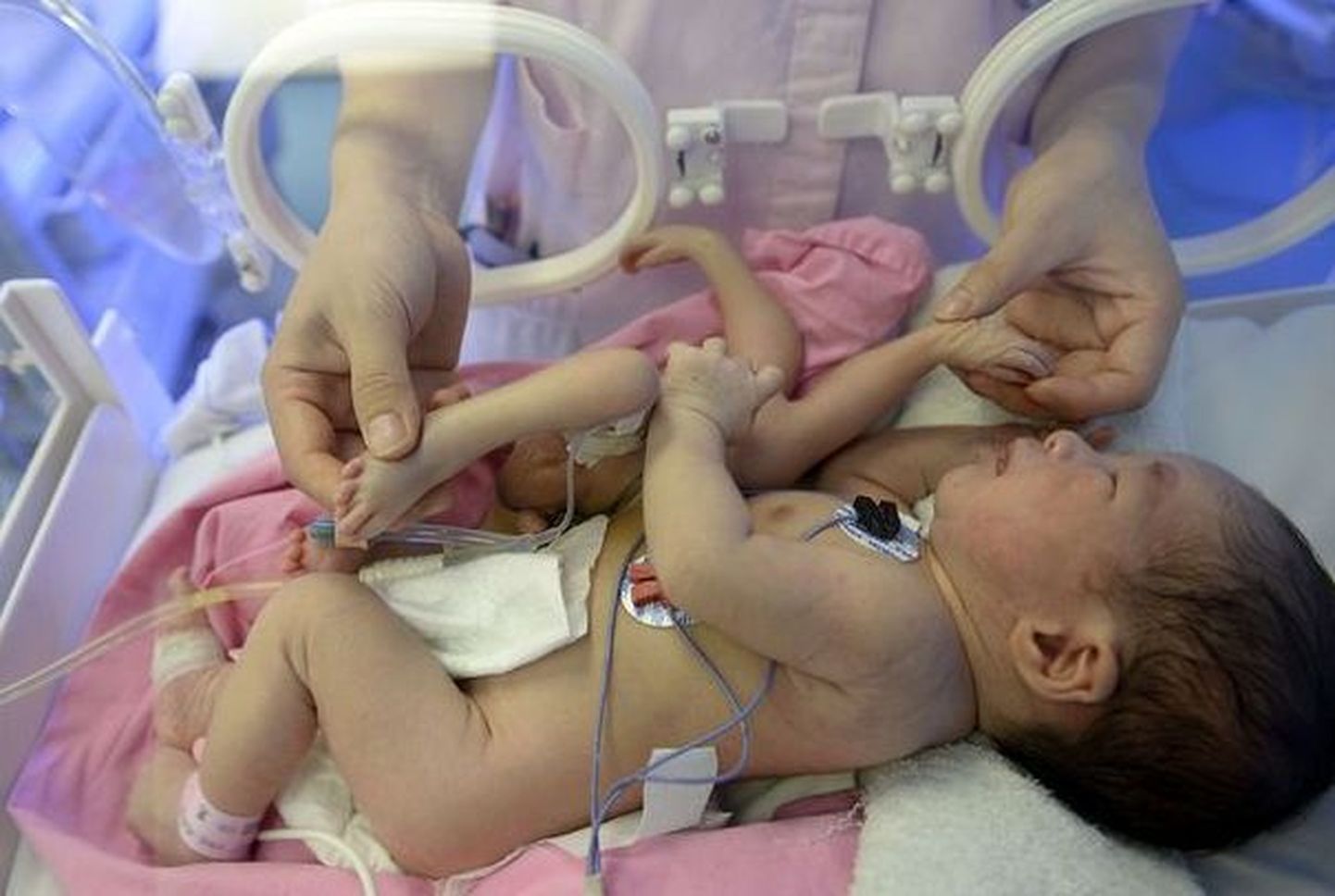 Hiinas sündis nelja jala ja nelja käega laps