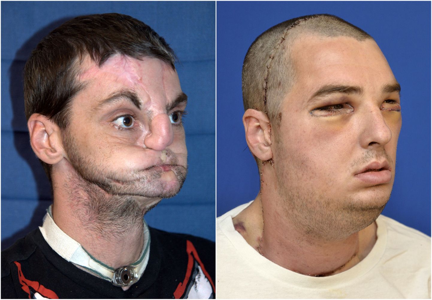 Richard Norris enne ja pärast operatsiooni