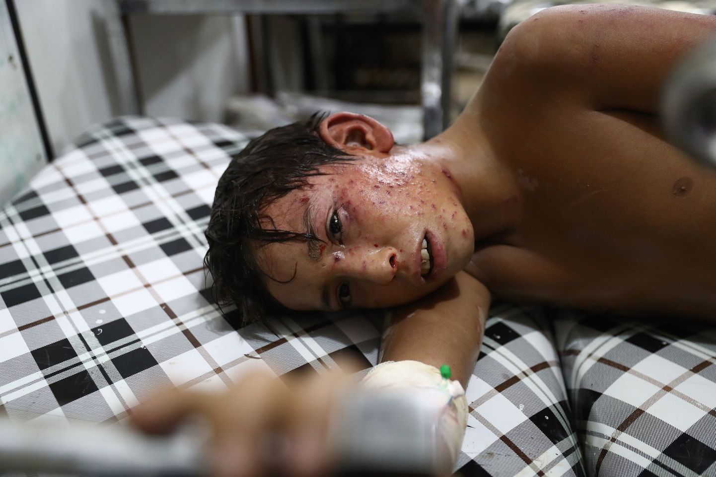 Süüria valitsusväed pommitavad samuti linnasid. Pildil Douma lähistel viga saanud poiss haiglas.