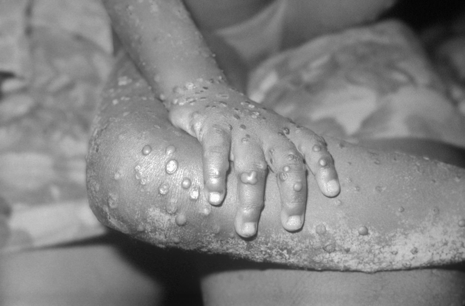 Nii näevad välja ahvirõugete villid nelja-aastase tüdruku kätel ja jalgadel.