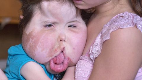 Эта девочка страдает крайне редкой болезнью, врачи беспомощны перед жутким недугом