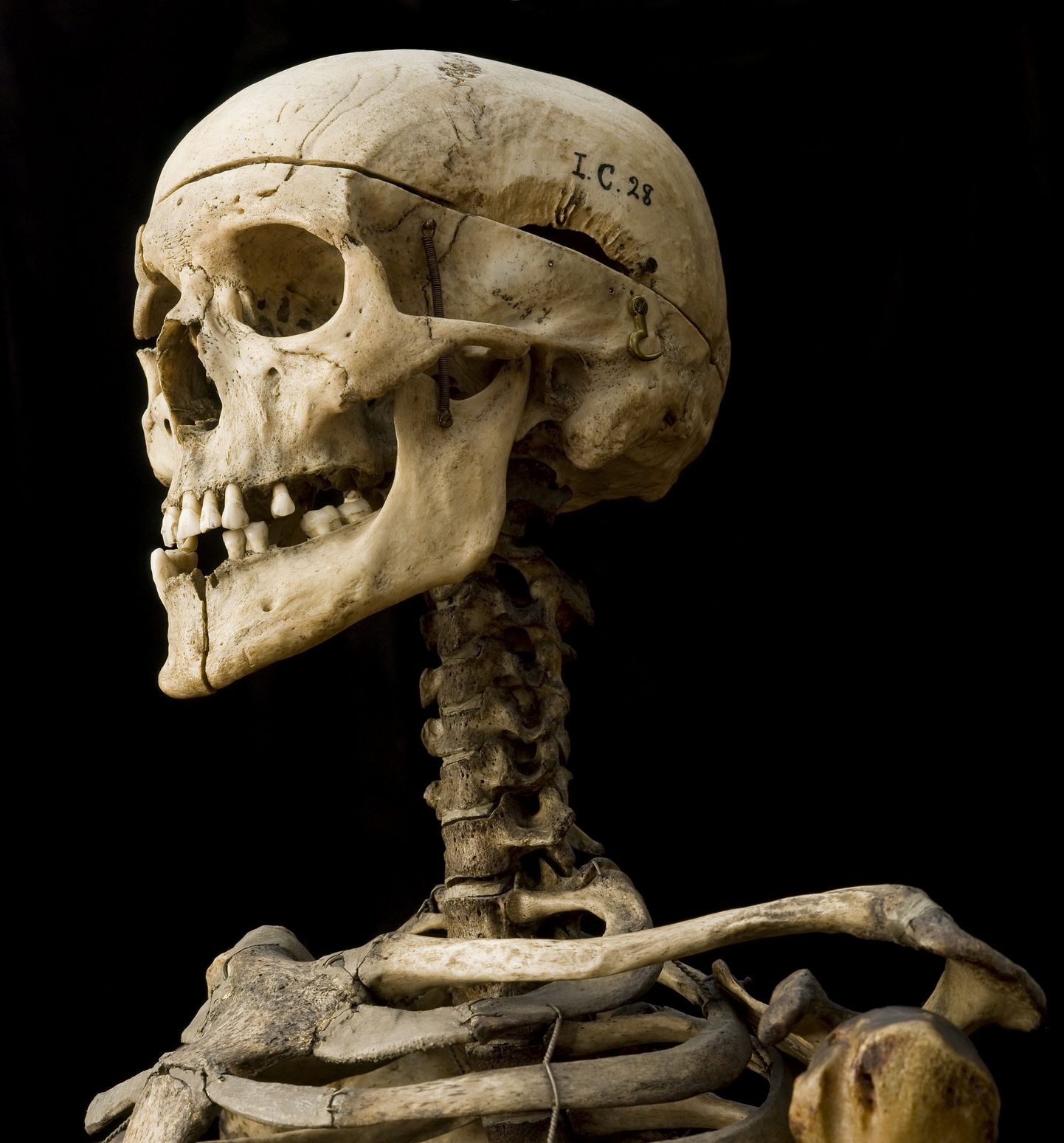 Скелет Уильяма Берка до сих пор хранится в Хирургическом музее Эдинбургского университета. Пригвожденный к позорному столбу за свои гнусные преступления, этот экспонат наверняка заставляет посетителей музея задуматься о вопросах медицинской этики.