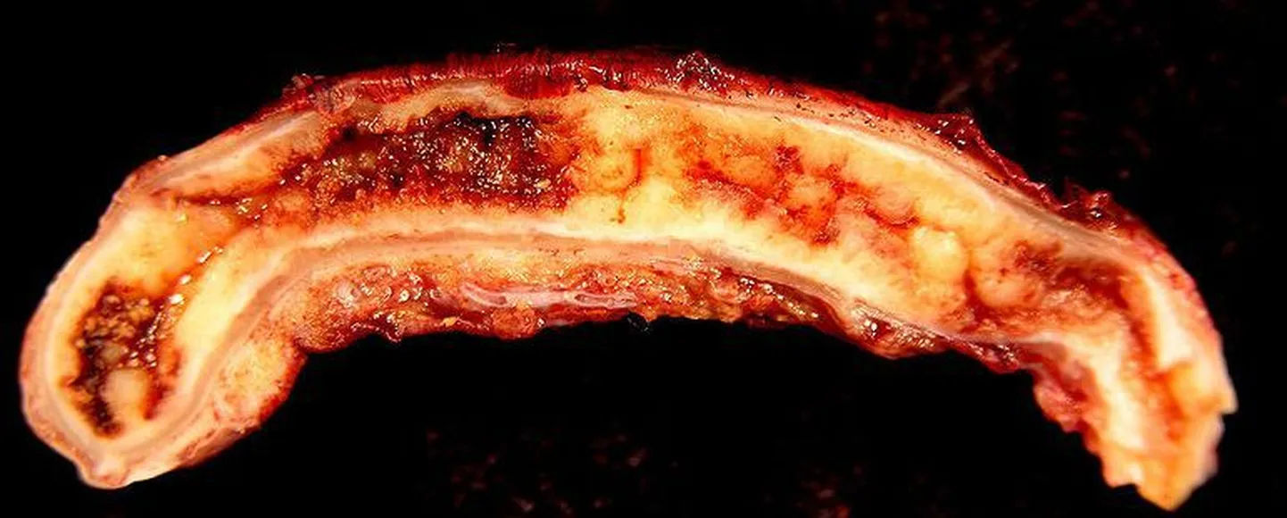 Põletikuline pimesool