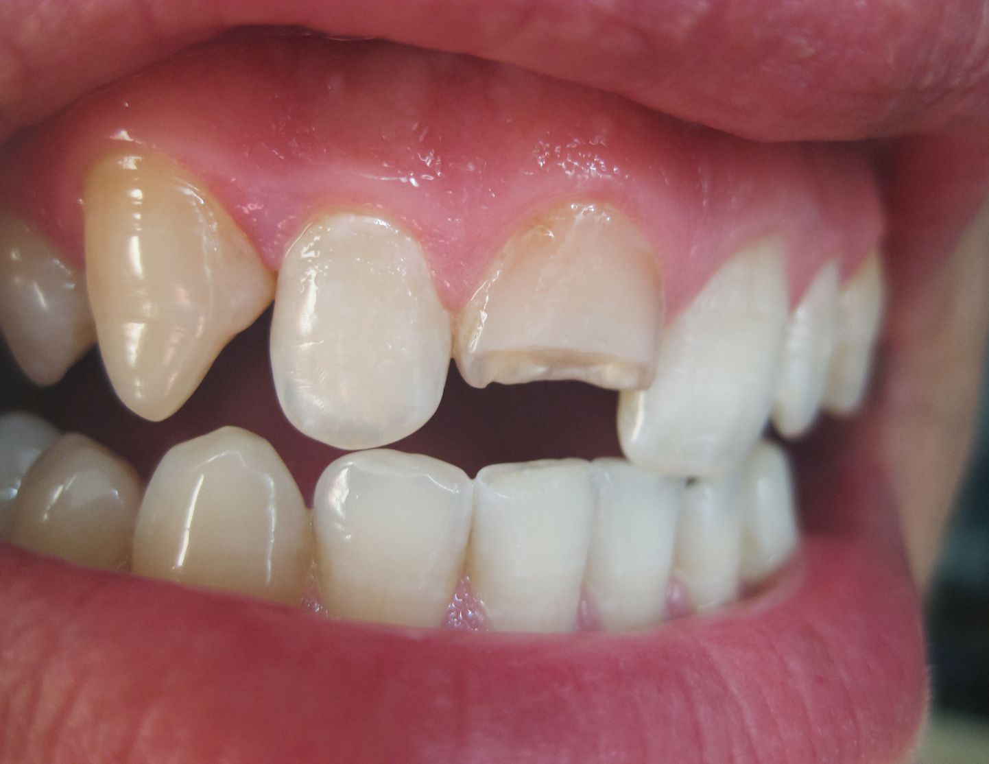 Kiiresti reageerides ning sõltuvalt trauma tõsidusest on võimalik murdunud hammas juure peale üles ehitada.