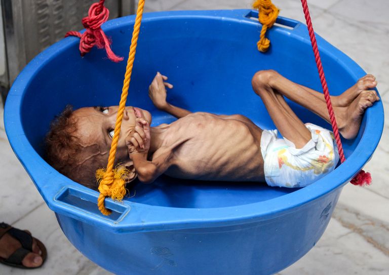 Alatoitunud laps Jeemeni Hajjahi provintsi haiglas.