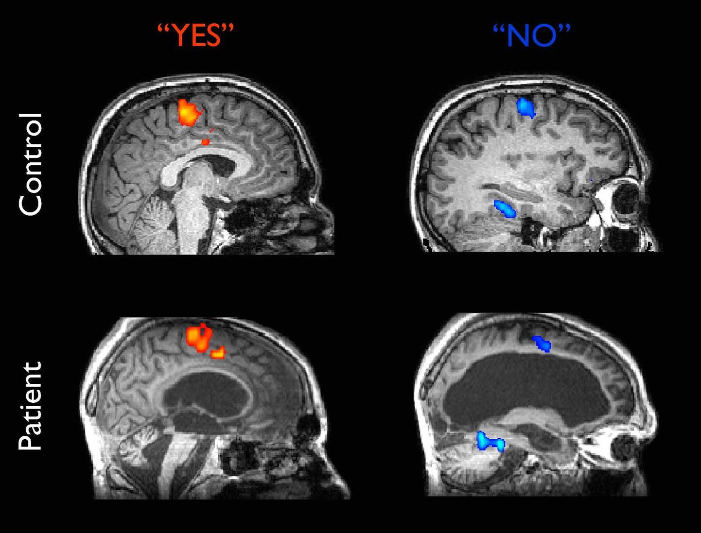 Aju aktiivsust näitav fMRI pilt. Üleval kontrollisiku aju aktiivsus, kui ta vastas küsimustele ja all vegetatiivses seisundis patsiendi aju aktiivsus vastamise ajal