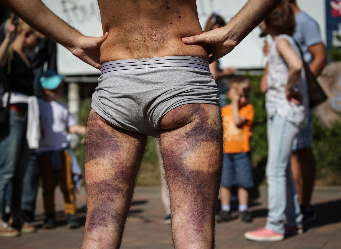 Vardarbības pēdas pēc iznākšanas no izolatora Minskā 2020.gada 15.augustā