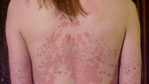 Psoriaas seljal. Psoriaas seljal.