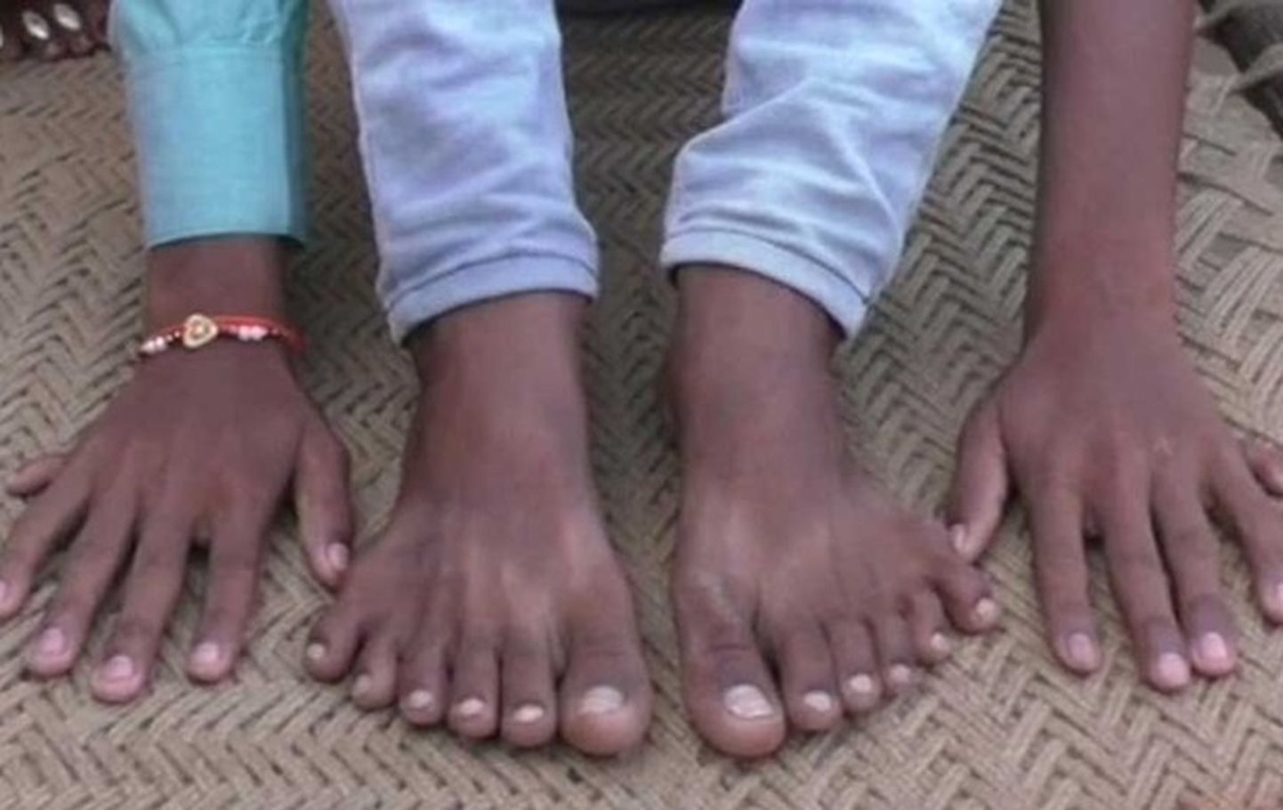 Ребенка с шестью пальцами спасают от жертвоприношения