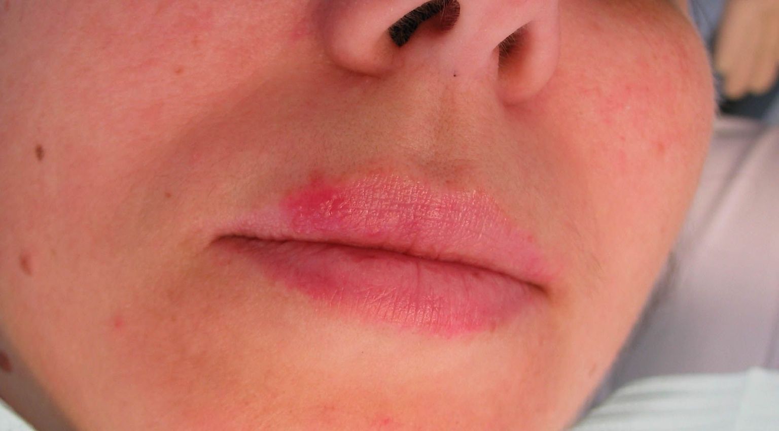 Huuleohatis ehk huuleherpes on üks inimese levinumaid viirushaigusi, mida pole võimalik täiesti välja ravida. Enamik viirusekandjaid ei haigestu.