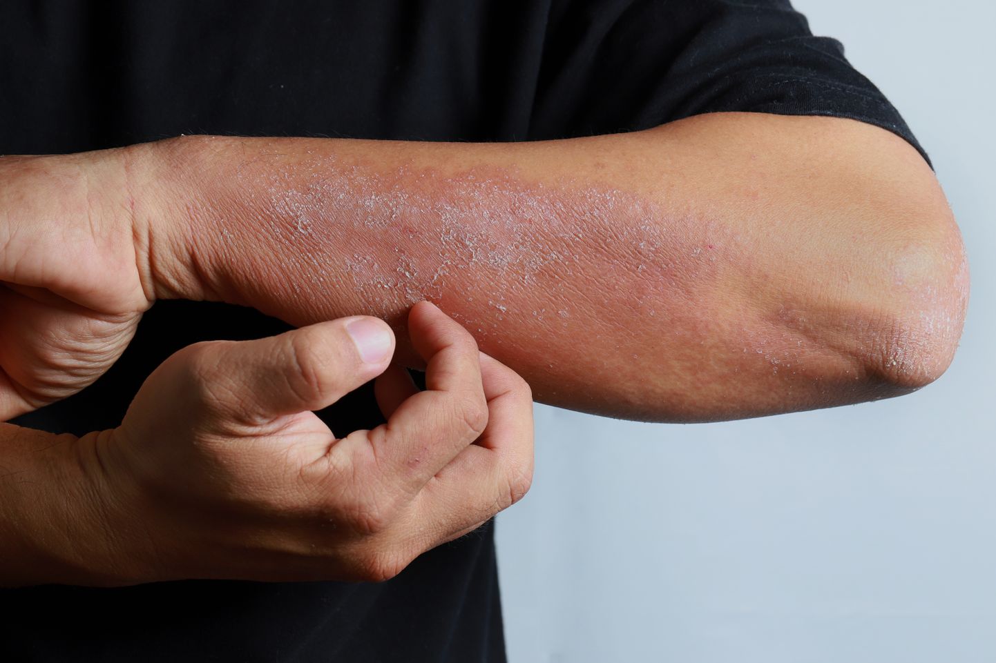 Atoopilise dermatiidi üheks ebameeldivaimaks sümptomiks on pidev sügelustunne.