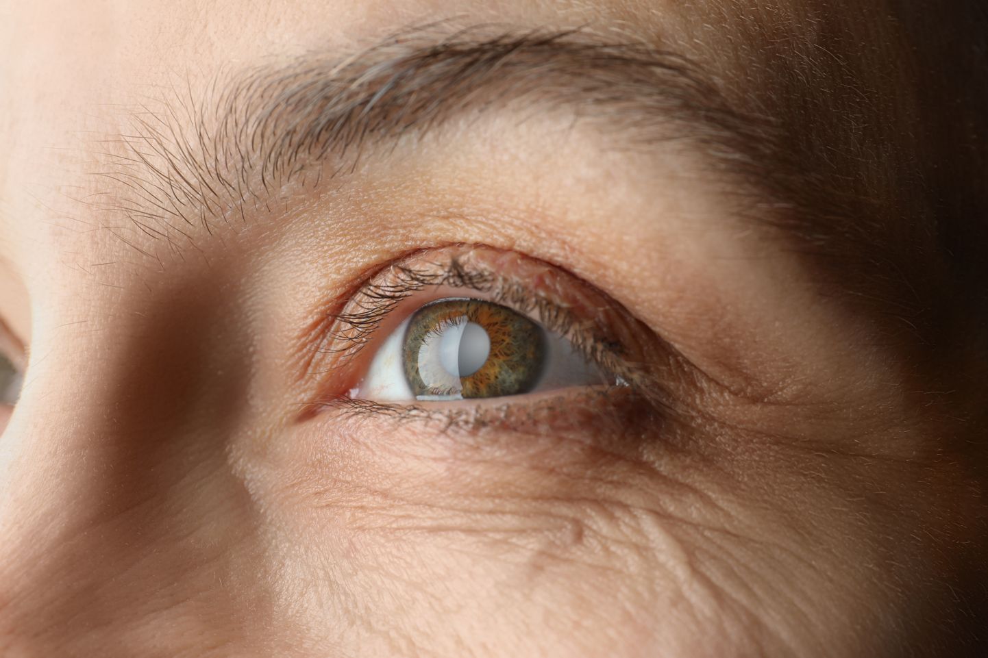 Koroonaviirus võib silmadele ajutiselt mõju avaldada. Pika Covidiga inimestel olid silmades ahenenud väikesed veresooned arterioolid.