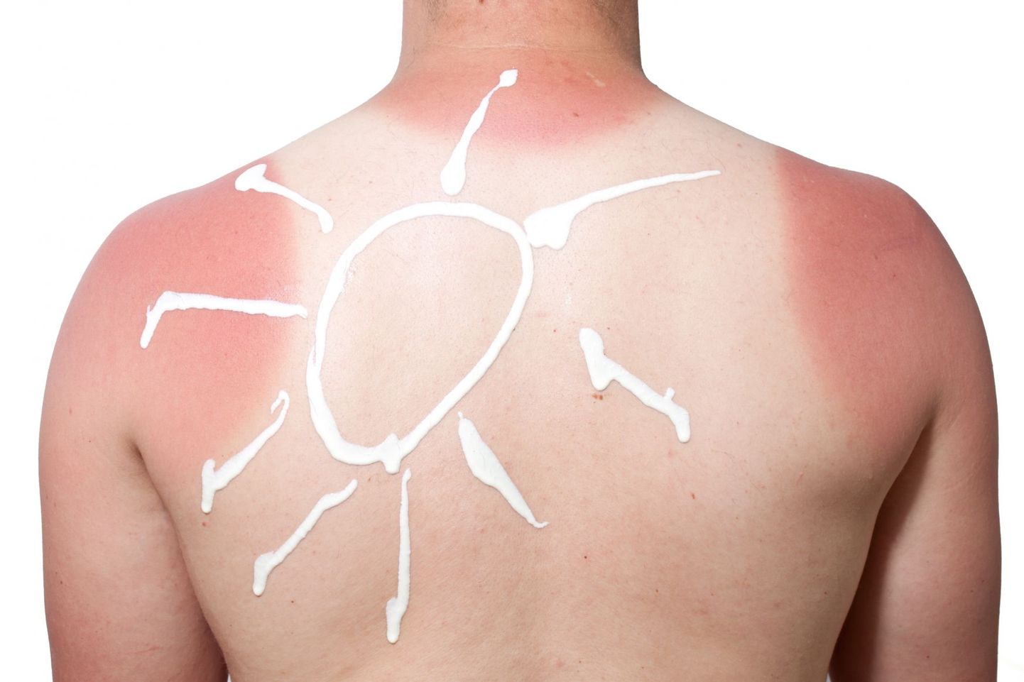 Päikesekreem ei kaitse nahahaiguste eest.