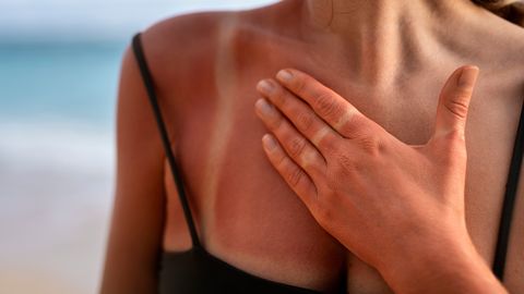 Arst avaldab: kas päikesepõletust tohib tohterdada hapukoorega?