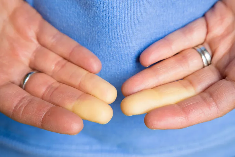 Raynaud’ sündroom. Foto: