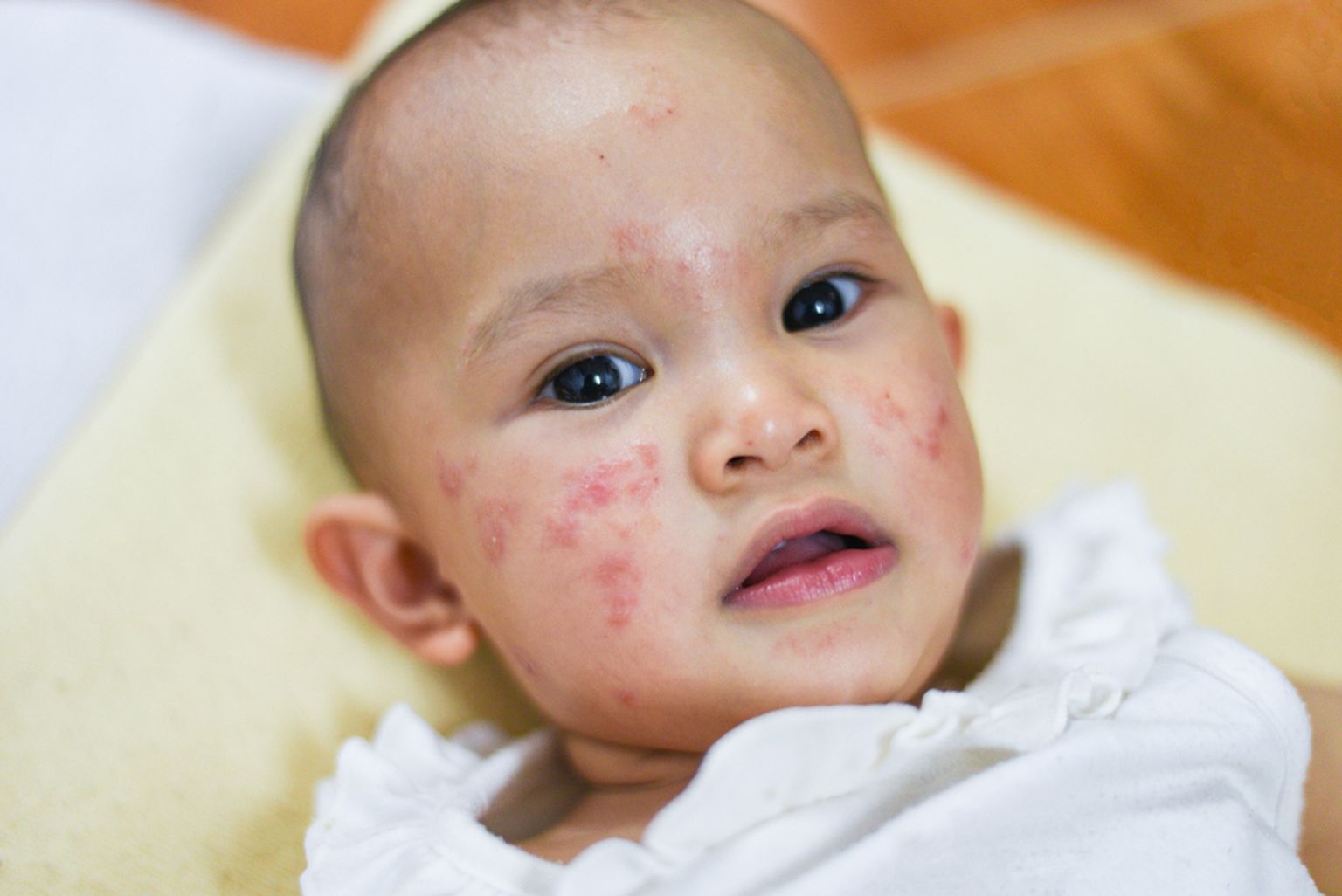 Toitumisteadlane selgitab: lastel esinevad allergiad, mis on põhjustatud toitudest