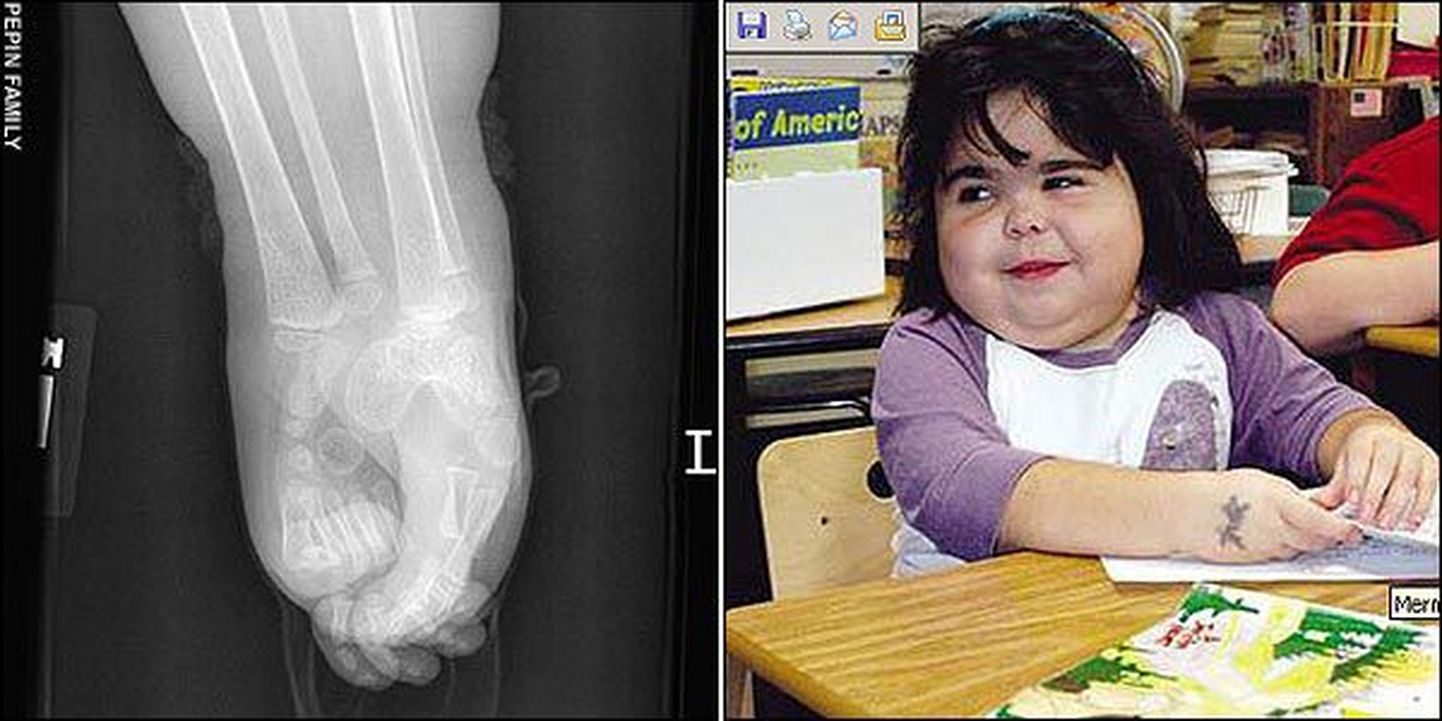 Shiloh Pepin ja röntgenpilt tema kokkukasvanud jalgadest
