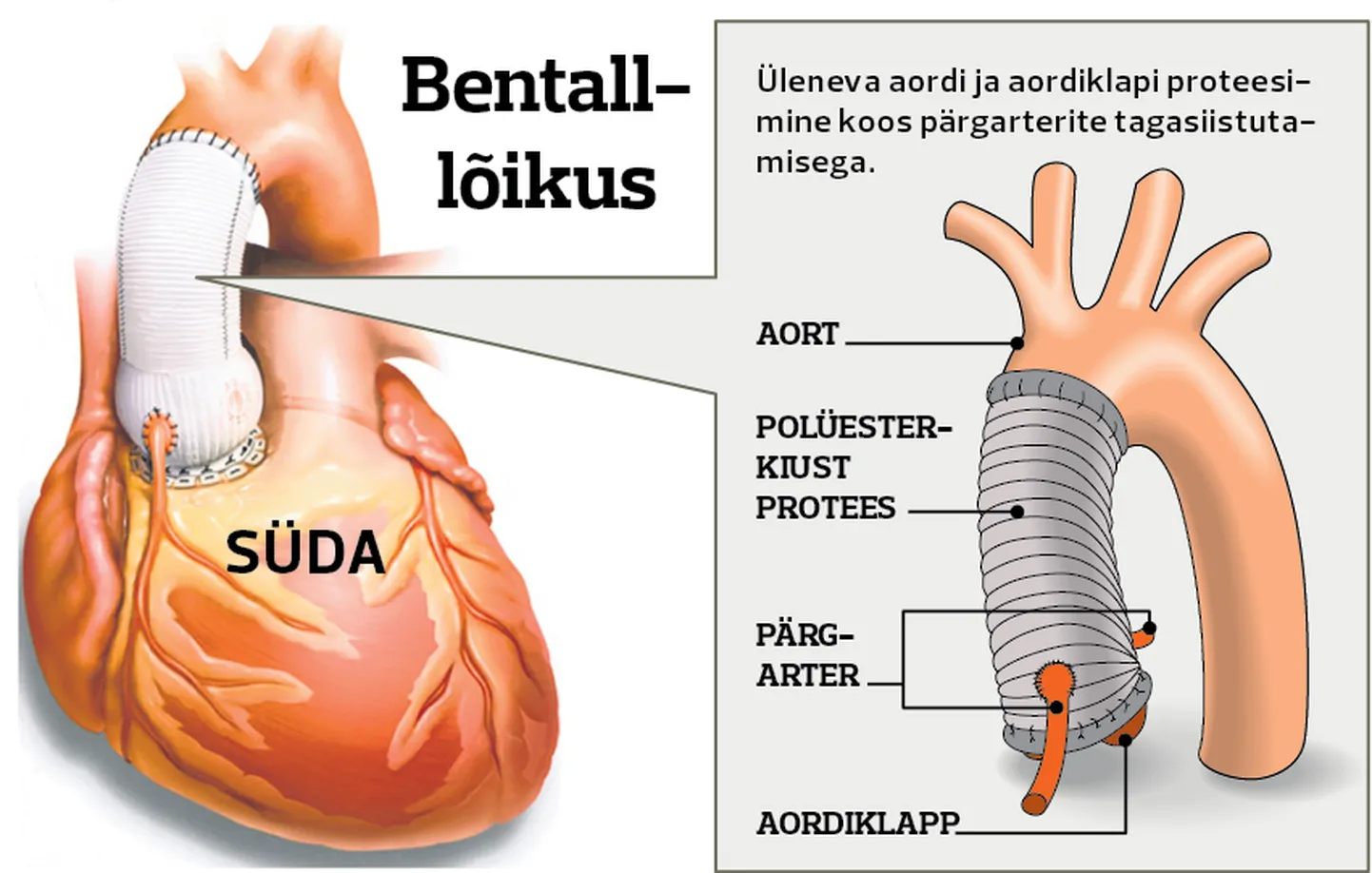 Bentall-lõikus