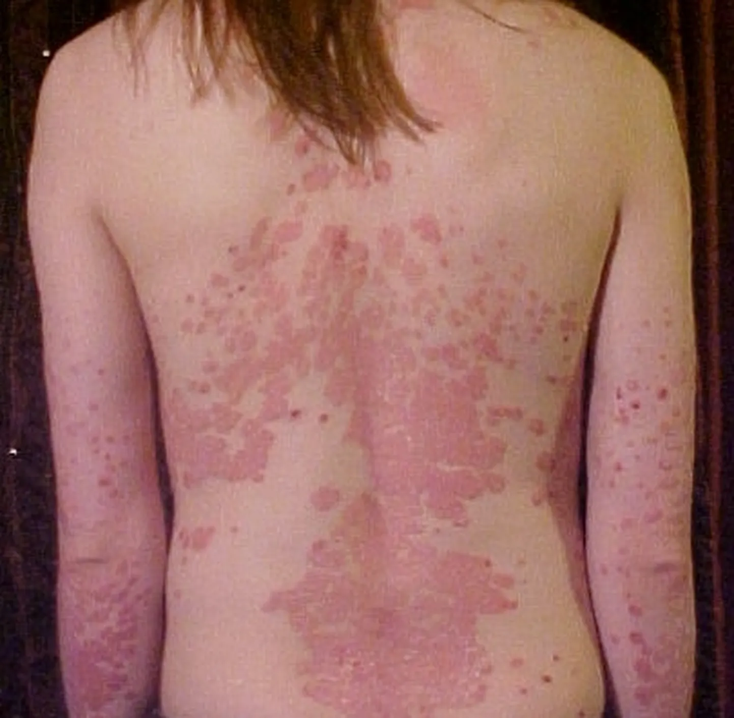 Psoriaas seljal.