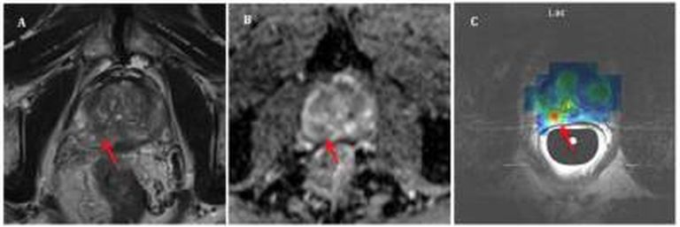 Hüperpolariseeritud MRT uuring eesnäärmevähi kasvajast.