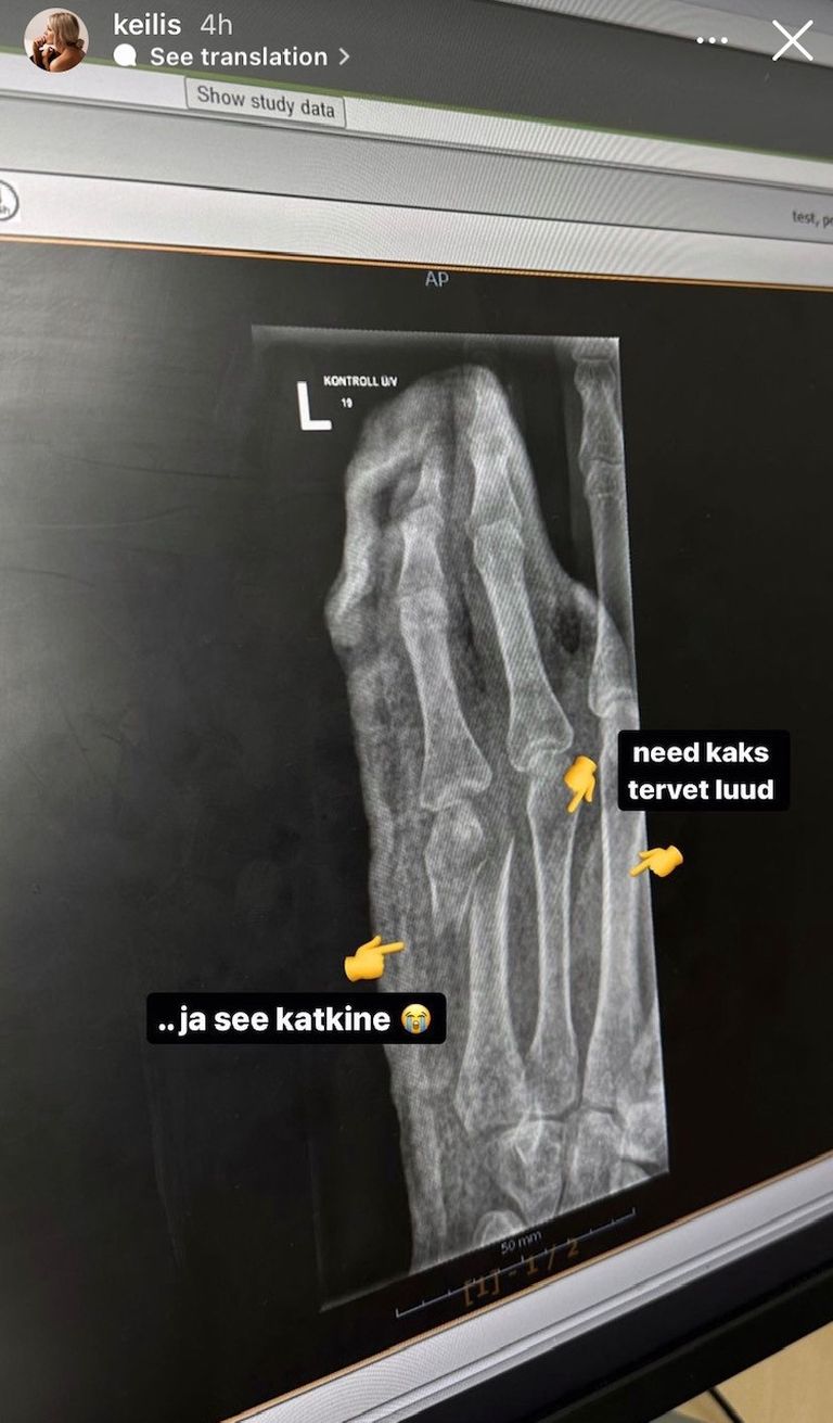 Кейли также показала своим поклонникам рентгеновский снимок перелома.