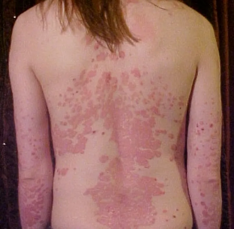 Psoriaas seljal.