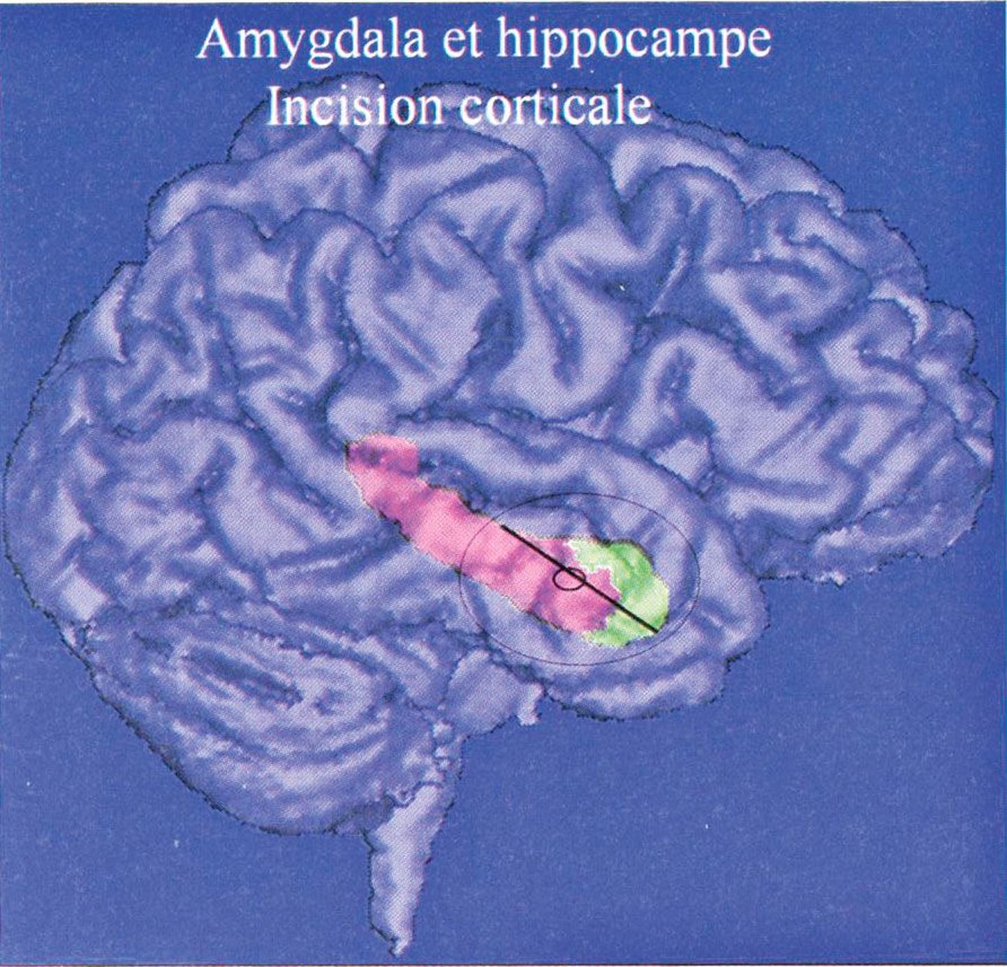 Aju oimusagara sisemuses olev hipokampus (roosa) ja mandeltuum (roheline), millest osa eemaldades on võimalik patsient epileptilistest hoogudest vabastada.