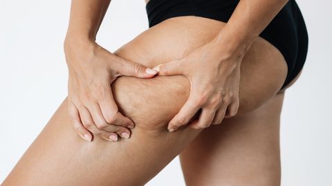 Plastikakirurg selgitab, miks tegelikult tselluliit tekib