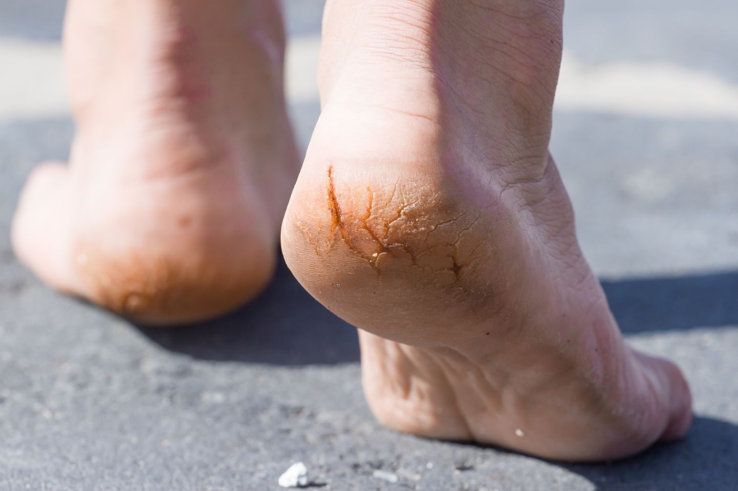Kuivad ja kannalõhedega jalad mõjutavad oluliselt inimese elukvaliteeti.