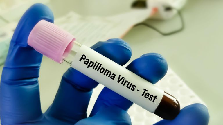 Надпись на пробирке: тест на вирус папилломы