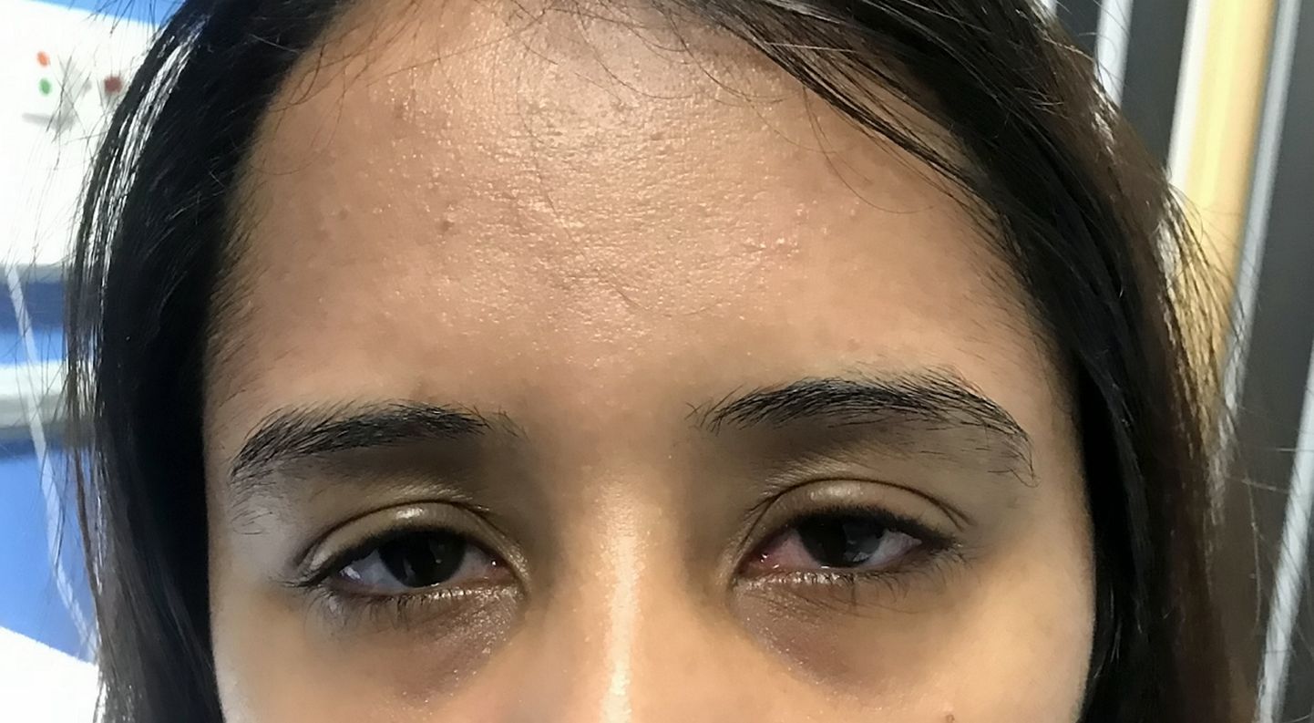 Gurcharan Kauri silm enne testi. Silm punetas ning naisele endale tundus, et tal on allergia.