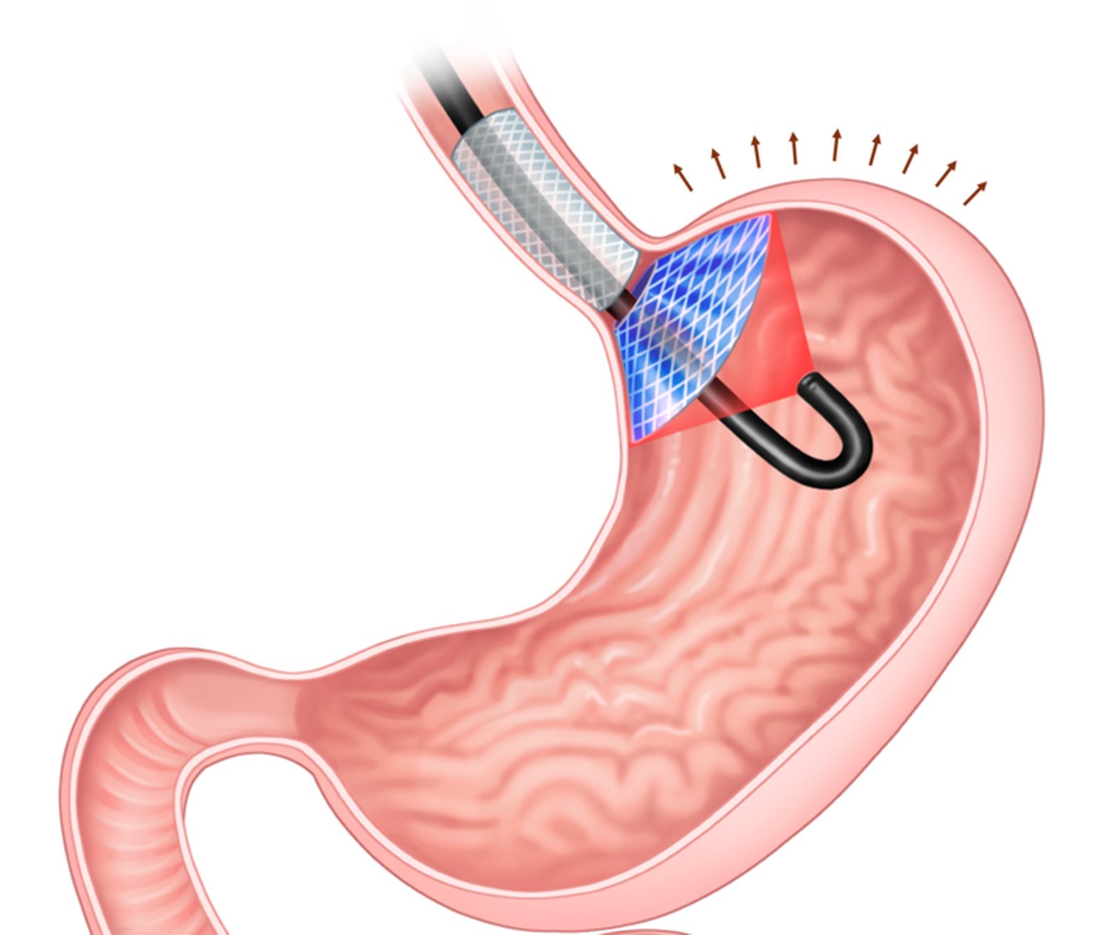 Sellel illustratsioonil tekitab implantaat (sinine ja hall) täiskõhutunde, survestades mao ülemist osa. Aktiveerimine laseriga (must) tapab rakke, mis toodavad greliini.