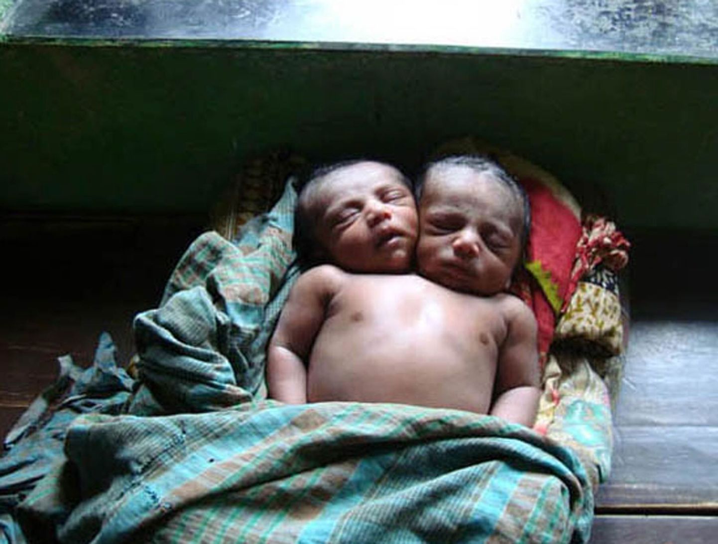 Bangladeshis sündis kahe peaga poiss