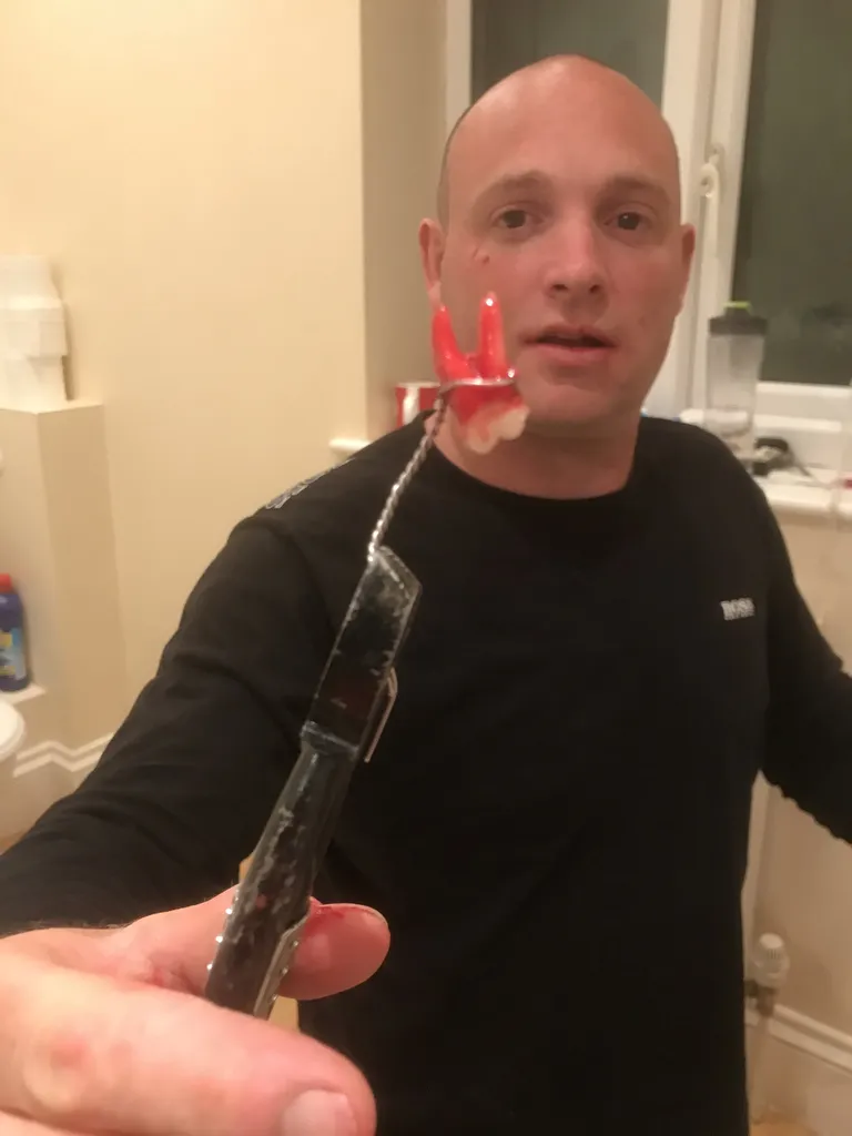 Mõni nädal tagasi jõudis meediasse lugu britist, kes samuti oma valutava hamba ise välja tõmbas. Billy Taylor jagas ka pilte oma välja tõmmatud hambast, kuid ei soovitanud kellelegi midagi sellist ise teha.