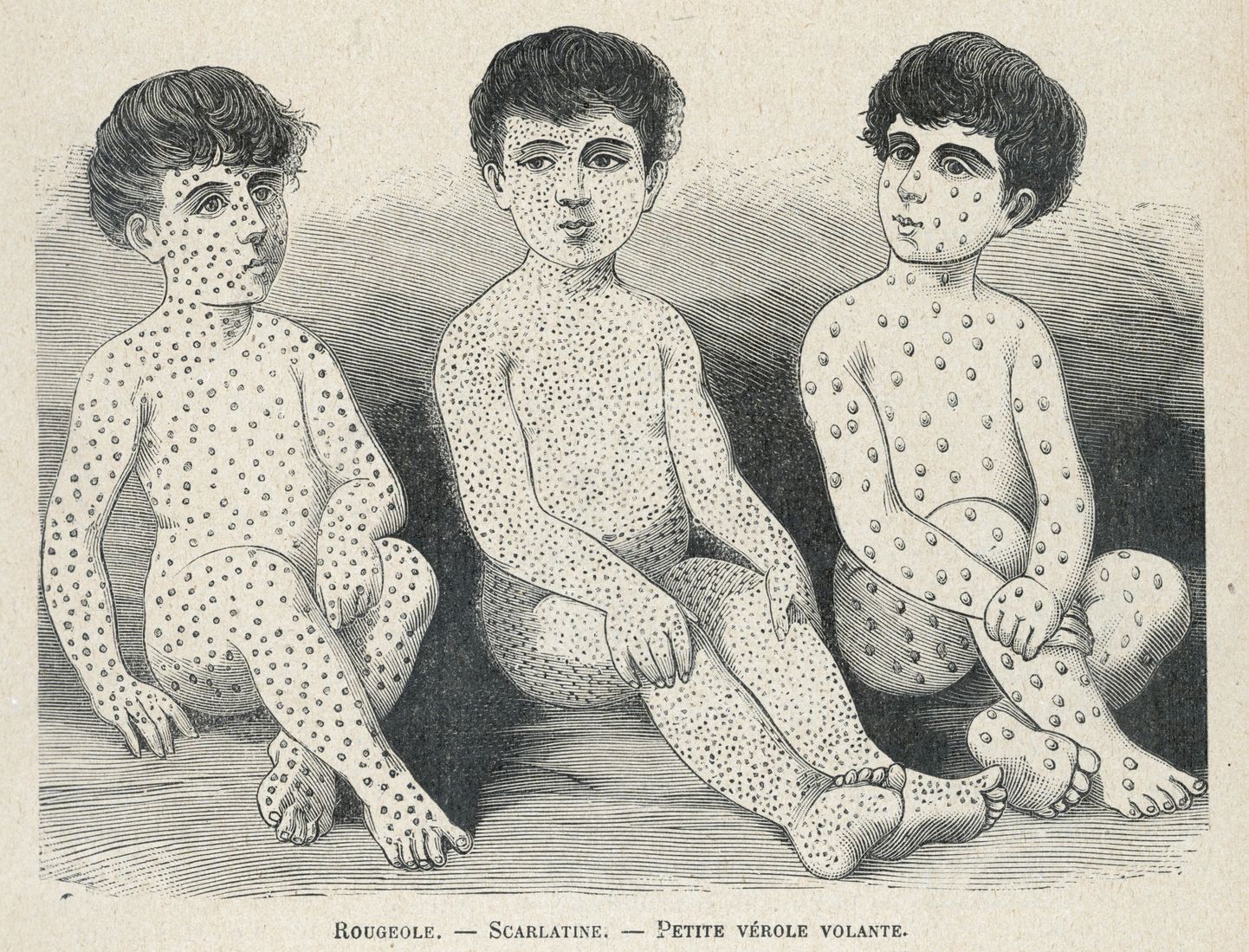 Plakat aastast 1880. Vasakpoolsel poisil on leetrid, keskmisel sarlakid ja parempoolsel rõuged.