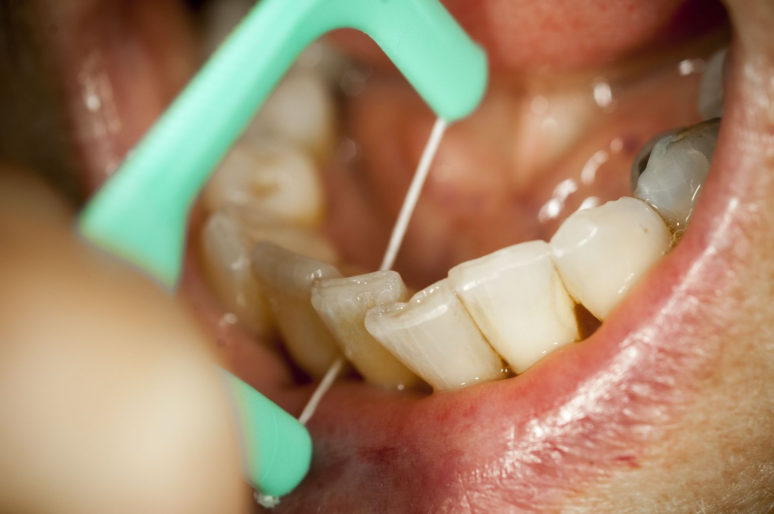 Hambaravihüvitise mõistliku suuruse üle on viimasel ajal palju vaieldud.