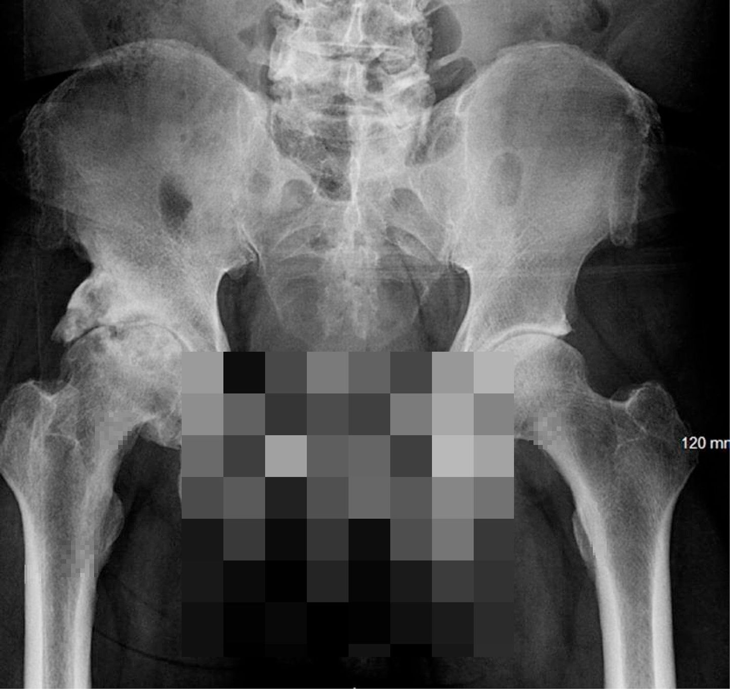 Sellest röntgenpildist selgus, et mehe peenis oli mõnda aega luustunud.