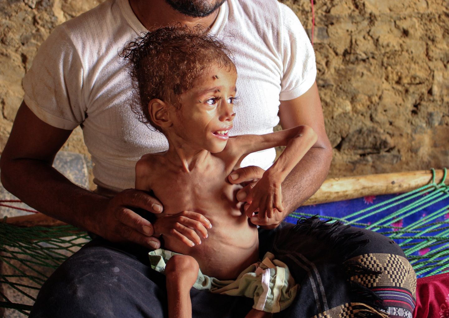 Alatoitumuse käes kannatav jeemenlane isa süles.