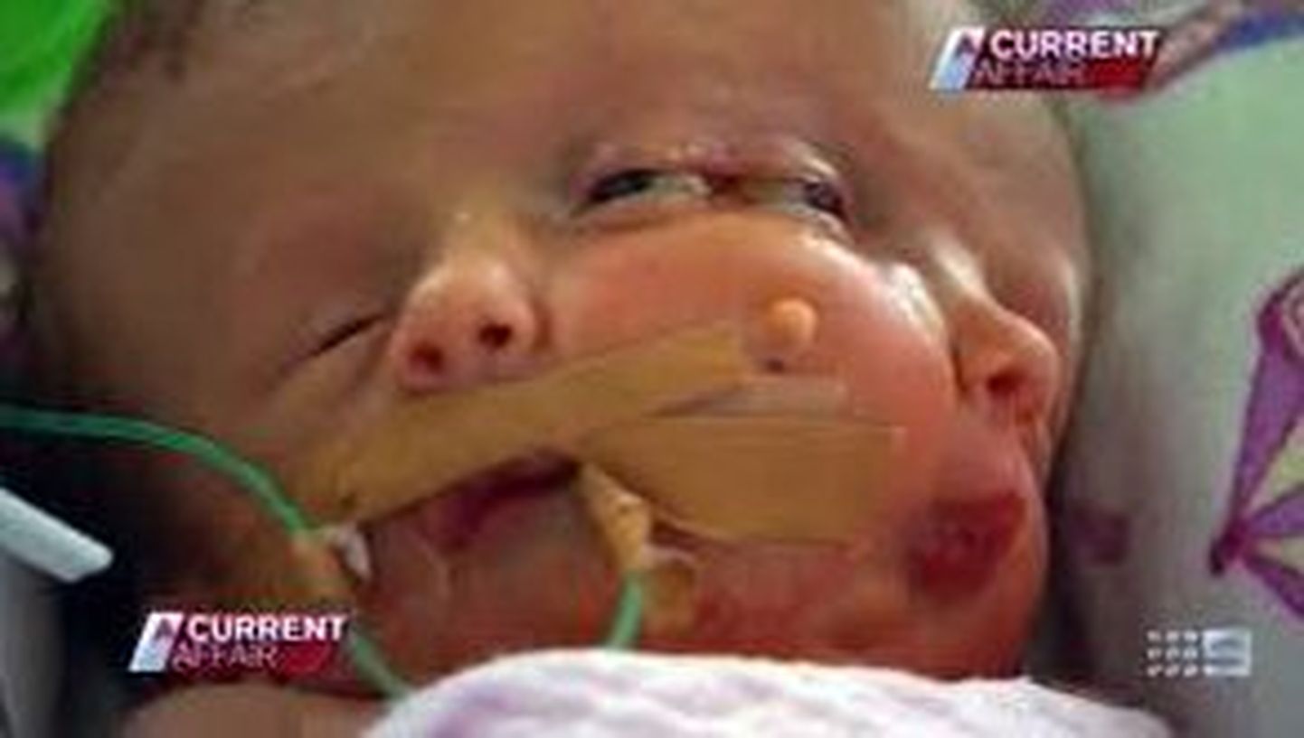 Austraallanna sünnitas kahe näoga lapse