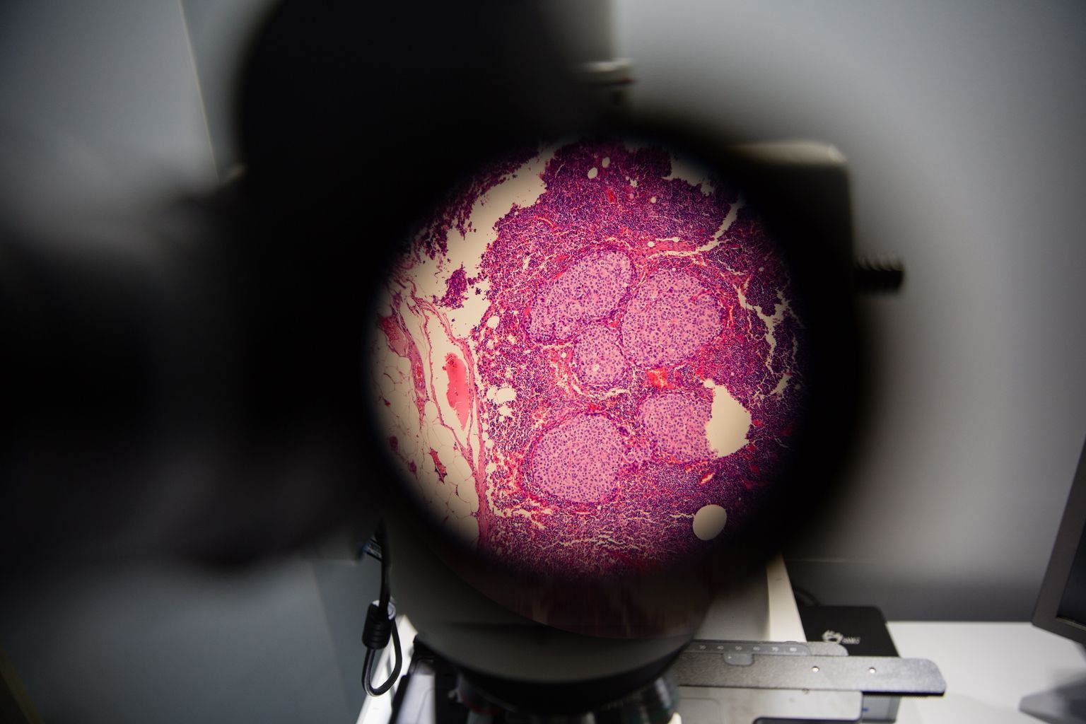 Vähirakud mikroskoobi all. Pilt on illustreeriv.