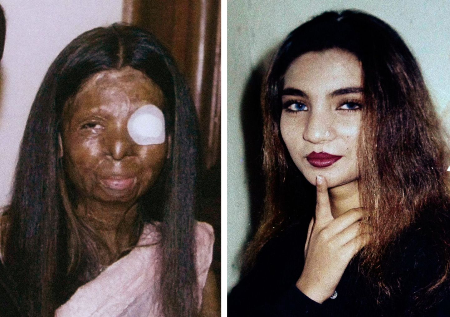 Fakhra Younus enne ja pärast happerünnakut