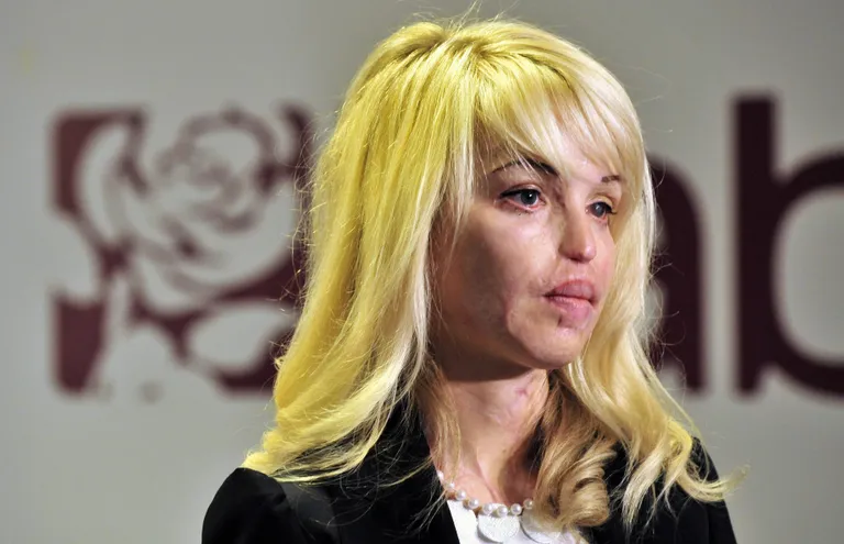 Endine modell Katie Piper 2010. aastal, ligi kaks aastat pärast happerünnakut.