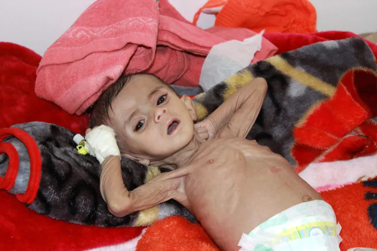 Alatoitunud laps Jeemenis.