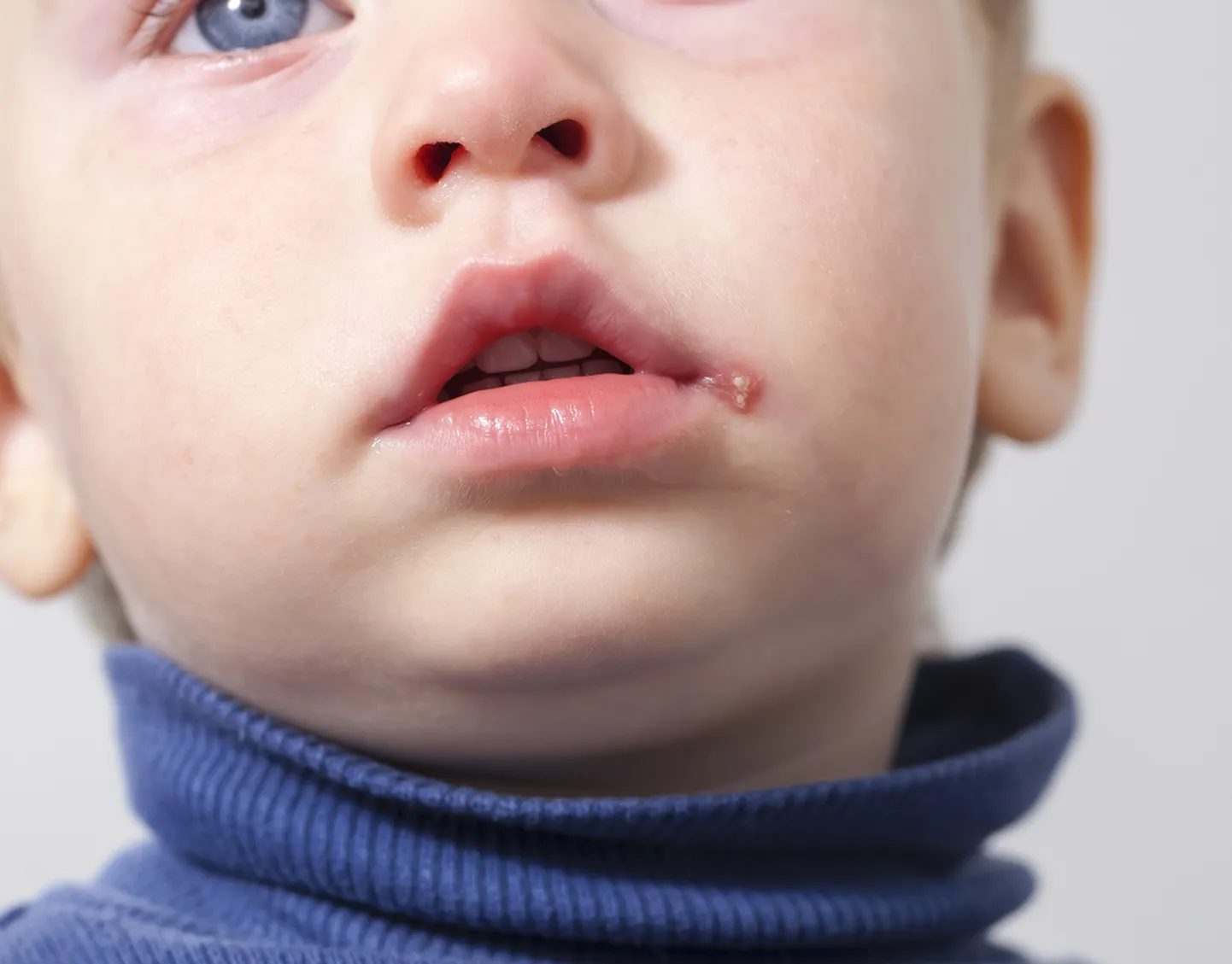 Mitte ainult huulte probleem: herpes ronib silma ja mujalegi