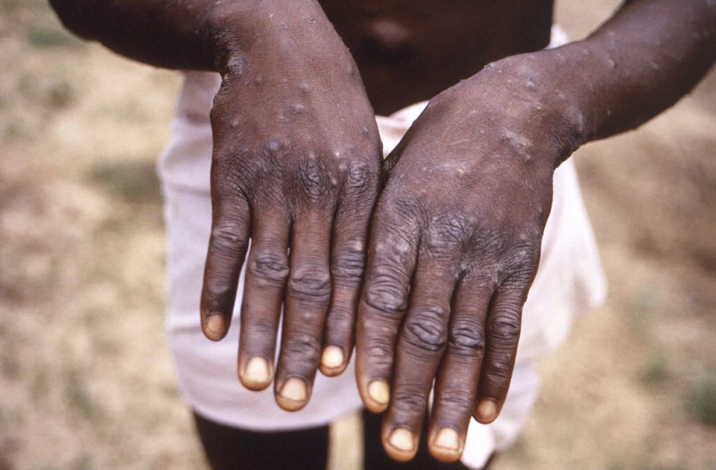 Ahvirõuged. Foto on tehtud 1997 Kongo Demokraatlikus Vabariigis, kus oli selle haiguse puhang