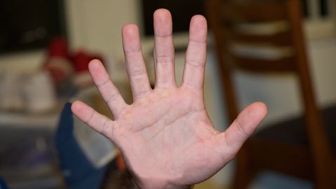 ФОТО И ВИДЕО ⟩ Мужчина с 12 пальцами показал, что может делать своими руками