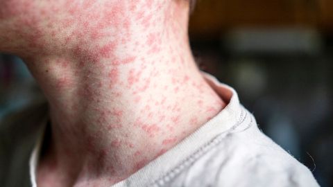 Lätis möllavad leetrid. Uus näitus hoiatab unustatud haiguste naasmise eest