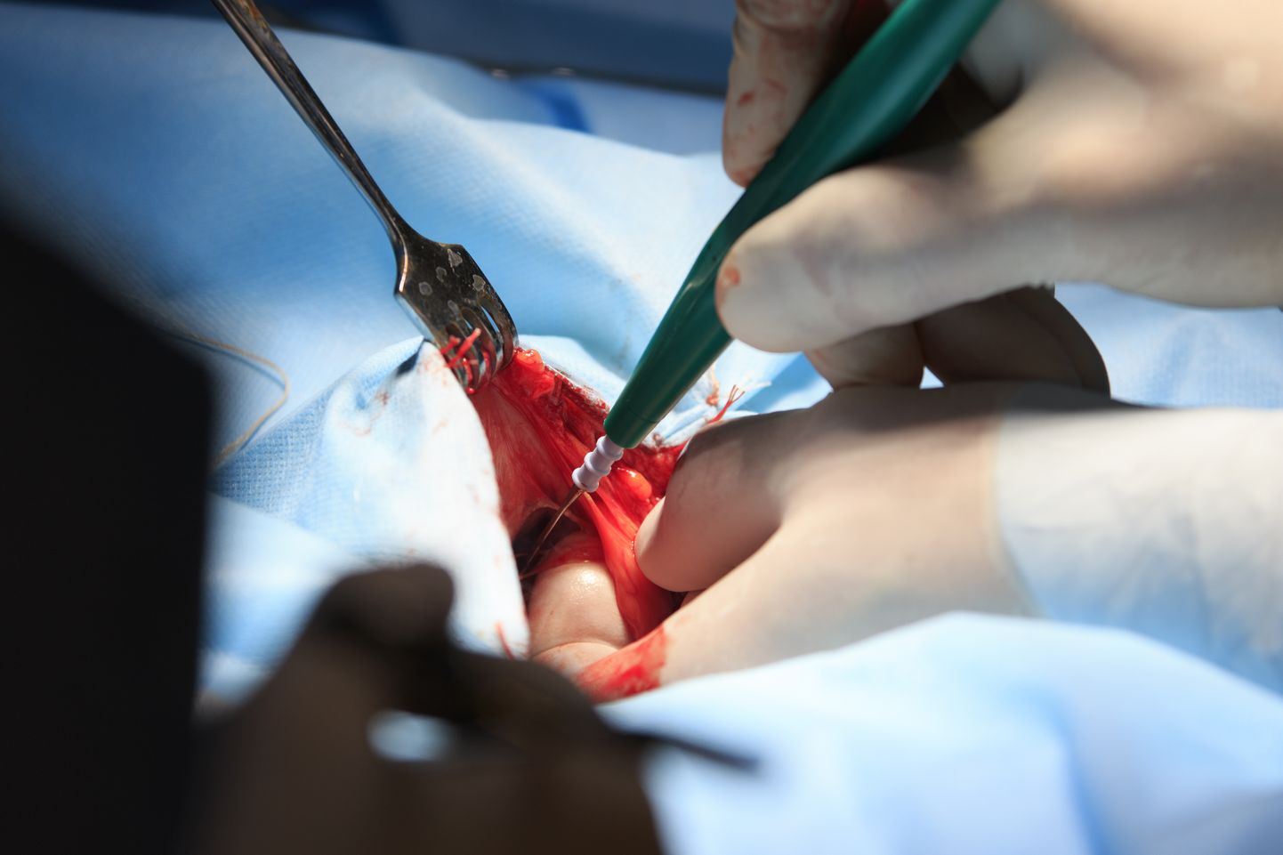 Хирург проводит операцию с помощью электроскальпеля.